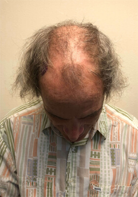 hair transplant photos