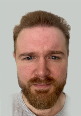 hair transplant photos