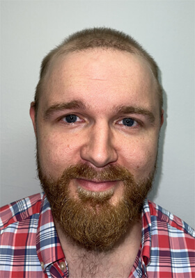 hair transplant photos