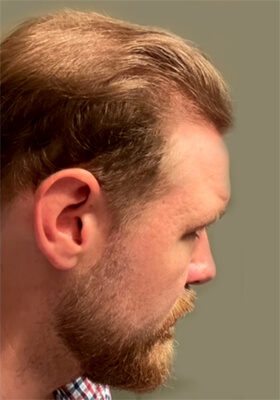 hair transplant photos