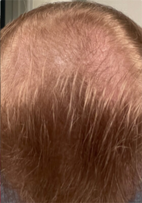 hair transplant photos