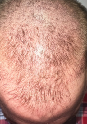 hair transplant before after Photos