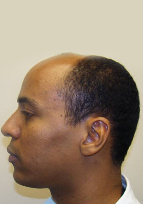 hair transplant photos