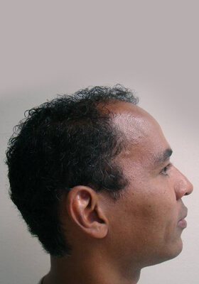 hair transplant photos