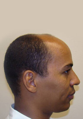 hair transplant photos