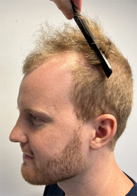 hair transplant photos