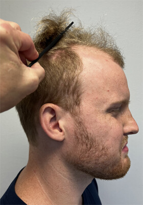 hair transplant photos