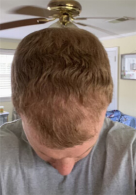 hair transplant before after Photos