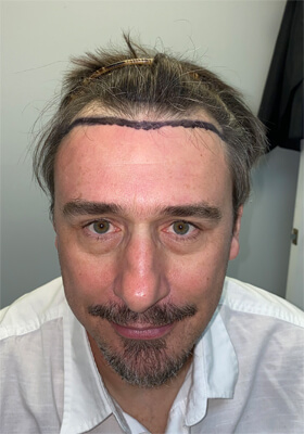 hair transplant before after Photos