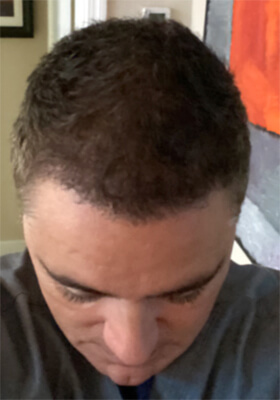 hair transplant before after Photos