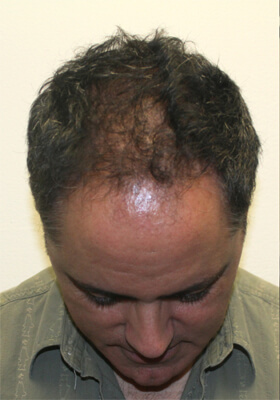 hair transplant before after Photos