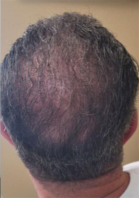 hair transplant photos