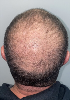 hair transplant photos