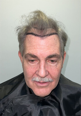 hair transplant photos