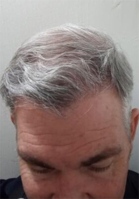 hair transplant photos