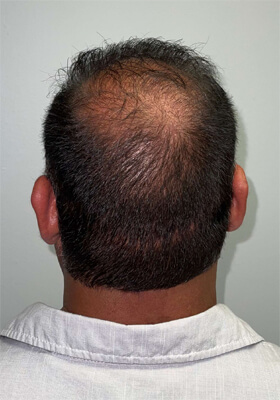 hair transplant photos