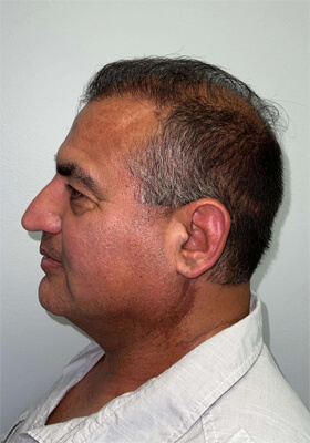 hair transplant photos