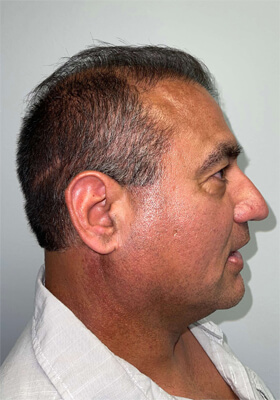 hair transplant photos