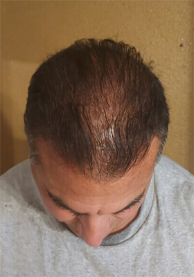 hair transplant before after Photos