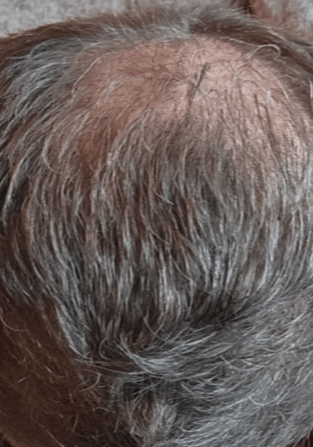 hair transplant before after Photos