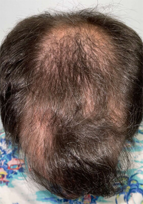 hair transplant before after Photos