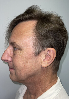 hair transplant photos