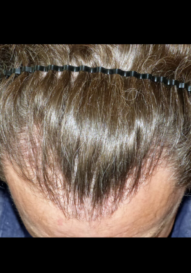 hair transplant before after Photos