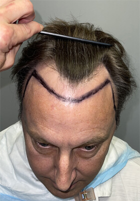 hair transplant photos