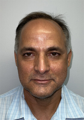 hair transplant photos