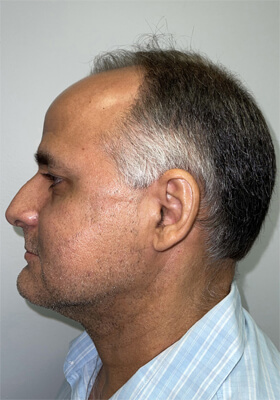 hair transplant photos