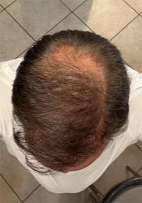 hair transplant before after Photos