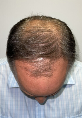 hair transplant before after Photos