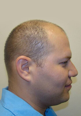 hair transplant photos