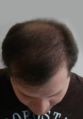 hair transplant photos