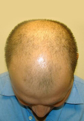 hair transplant before after Photos