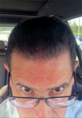 hair transplant photos