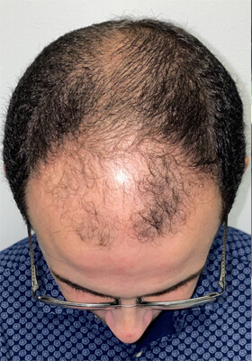 hair transplant before after Photos