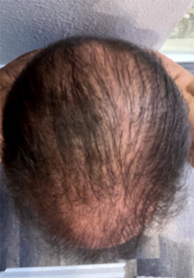 hair transplant before after Photos