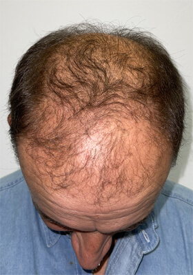 hair transplant photos