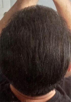 hair transplant photos