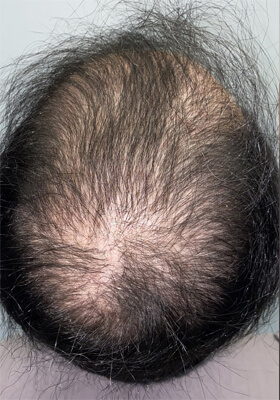 hair transplant photos