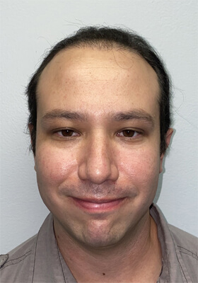 hair transplant before after Photos