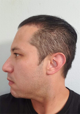 hair transplant photos