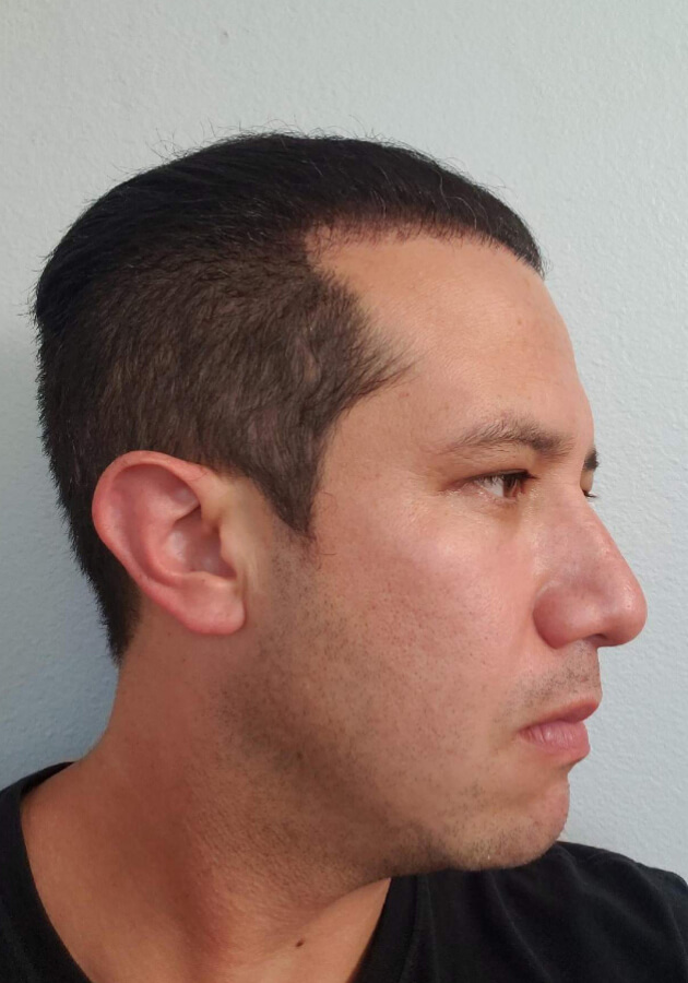 hair transplant photos