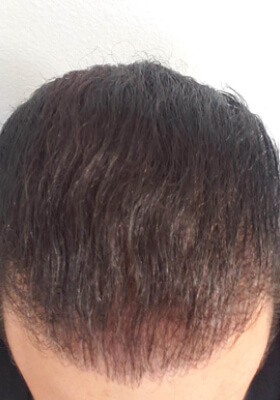 hair transplant photos