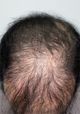 hair transplant photos