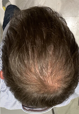 hair transplant photos