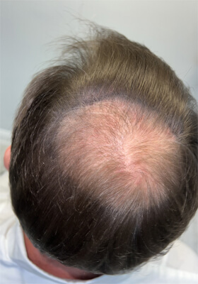 hair transplant before after Photos