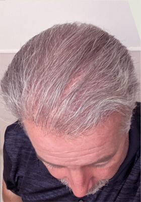 hair transplant before after Photos