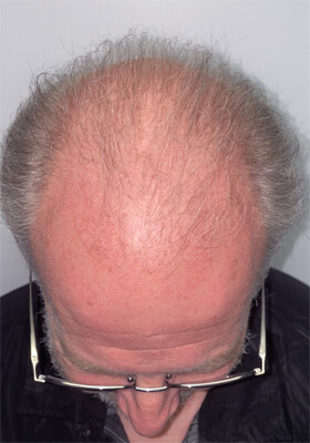 hair transplant photos